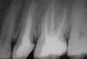Zahnarzt Krohn Endodontologie